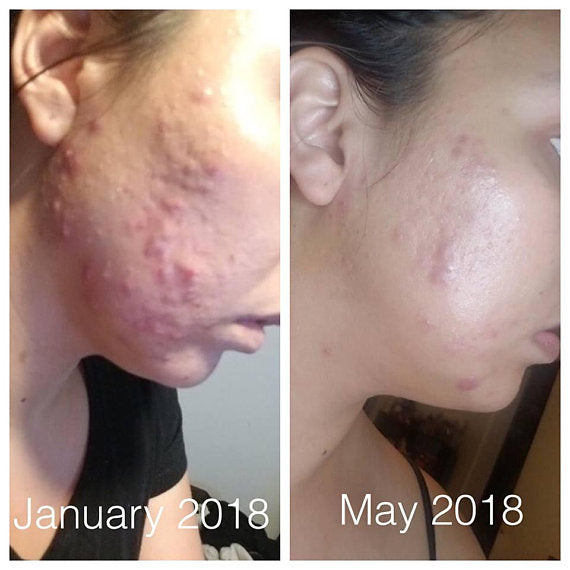 Super Acne Fighter โ Organic Acne Treatment Serum