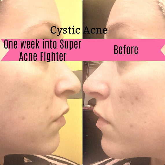 Super Acne Fighter โ Organic Acne Treatment Serum